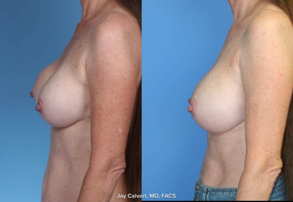 breast implant exchange gallery photos
